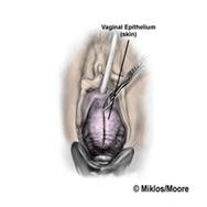 Anterior Colporrhaphy1