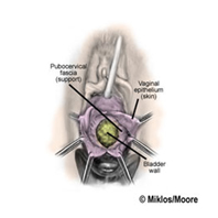 Anterior Colporrhaphy2