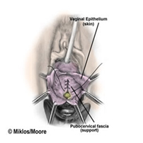 Anterior Colporrhaphy3