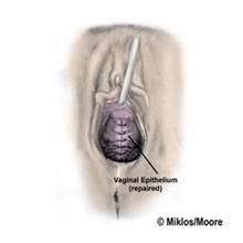 Anterior Colporrhaphy4
