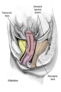 ApicalProlapse2