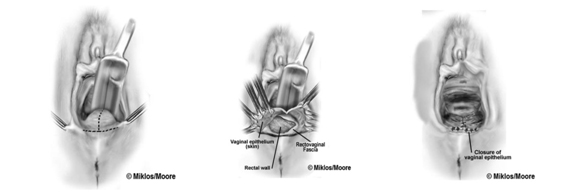 Immediately post op with reduction of the procidentia and perineorrhaphy.