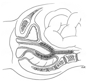 AbdominalSacralColopopexy
